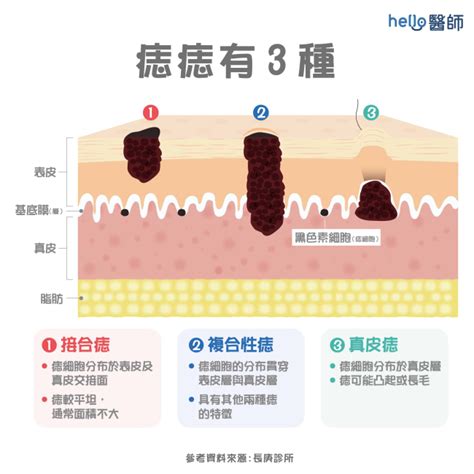 大痣|為什麼臉上的痣越來越多？皮膚科醫師解析長痣原因、。